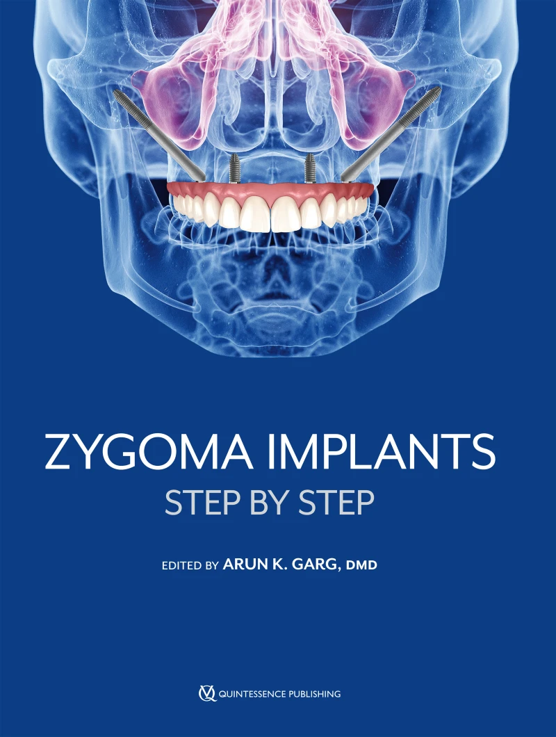 Portada: Zygoma Implants
