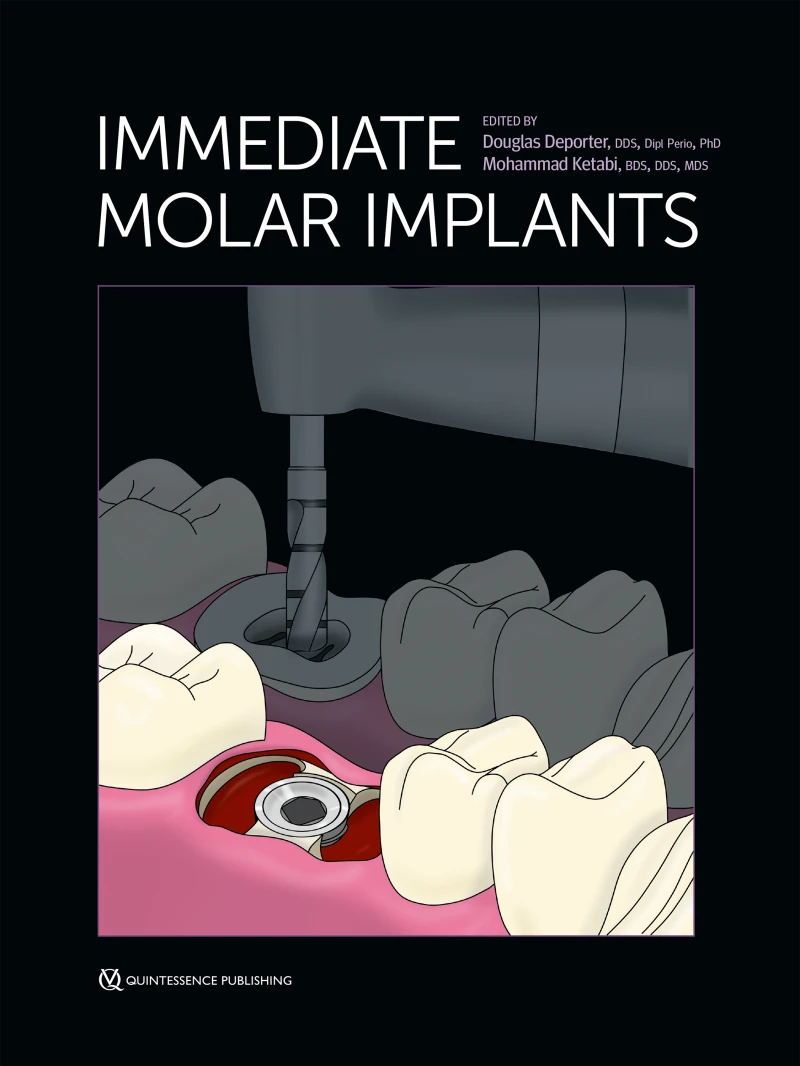 Portada: Immediate Molar Implants
