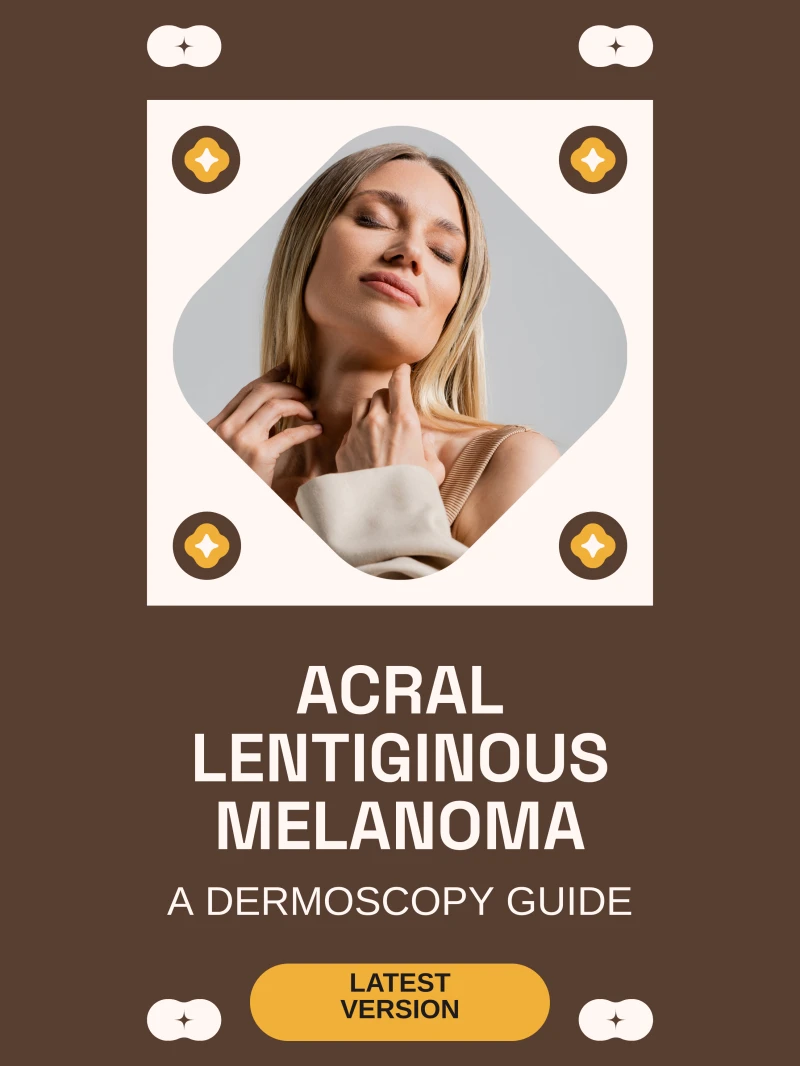 Portada: Acral Lentiginous Melanoma