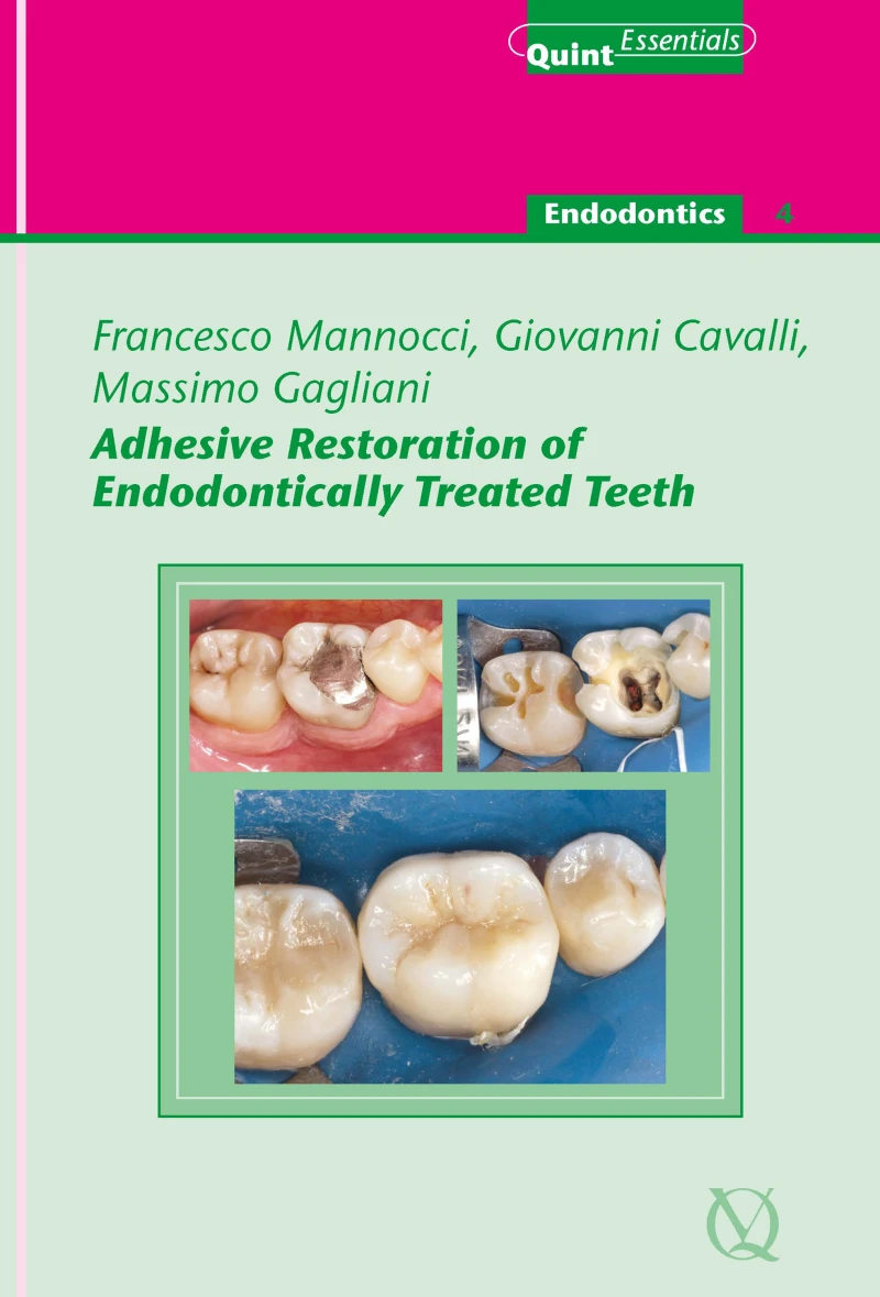 Portada: Adhesive Restoration of Endodontically Treated Teeth
