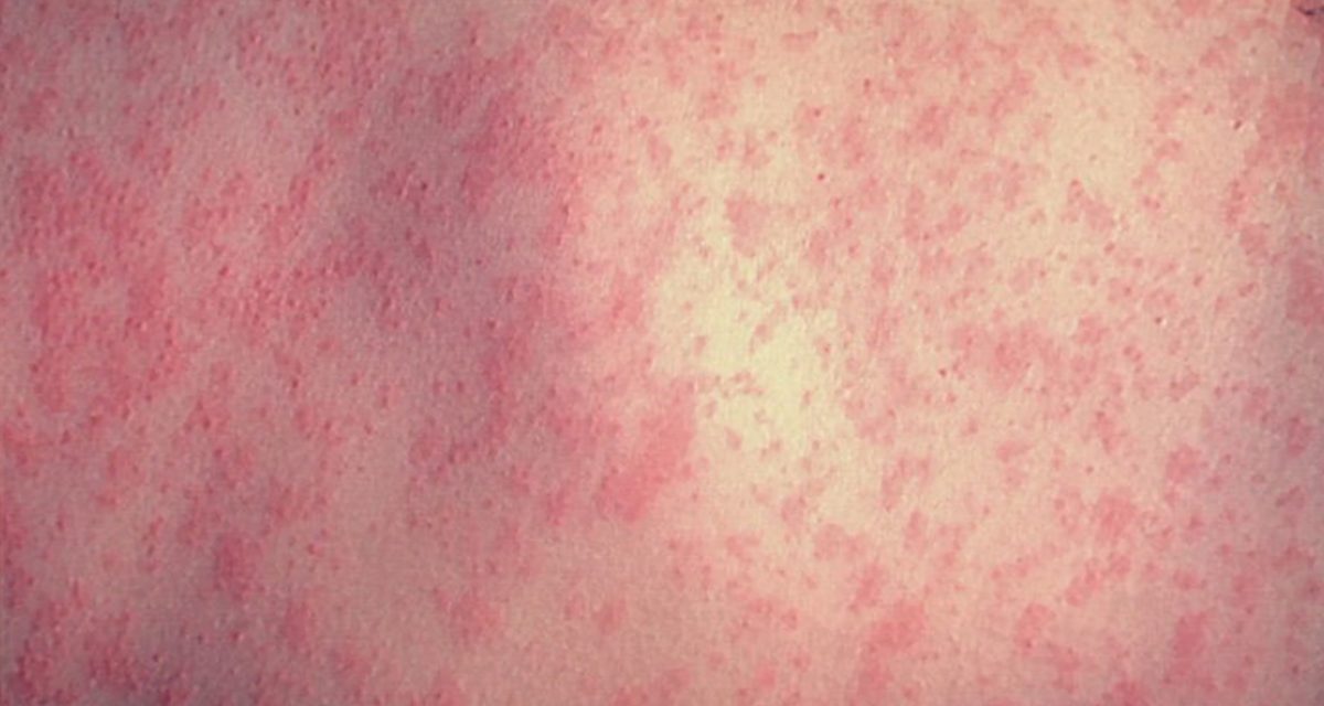 Measles cases climb across Laurentides