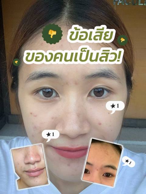 ⬇️มักเกิดจาก 3 สิ่งนี้⬇️
🧁อาหาร
😫ความเครียด
🙍🏻♀️ผลิตภัณฑ์ที่ไม่เหมาสม
สิ่งเหล่านี้อาจทำให้เกิดสิวได้ แล้วปัญหาพวกสิวเนี่ยบีมผ่านมาได้เพราะมีตัวช่วยที่บางคนอาจจะมองข้ามไป👀
💙 มอยส์แคปซูล เจลใสผสมเม็ดแคปซูล กู้ผิว10X เพิ่มความชุ่มชื้น พร้อมให้ความแข็งแรงแก่ผิวหน้า
💚 มาส์ก 7-11 มาส์กก่อนแต่งหน้า / ก่อนนอนช่วยฟื้นฟูผิวแบบเร่งด่วน
แค่ใช้ Set นี้เป็นประจำก็ช่วยให้สิวลดลง และการสะสมของแบคทีเรียก็จะจางลงเช่นกันเผยให้ผิวของเรากลับมาสดใสอีกครั้ง❣️✨
#tiktokฮาวทู #สิว #ปัญหาสิว #รีวิวสกินแคร์
