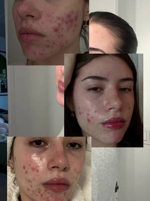 #neutrogenapartner It's acne awareness month and I just want you to know how beautiful you are with or without acne @Neutrogena