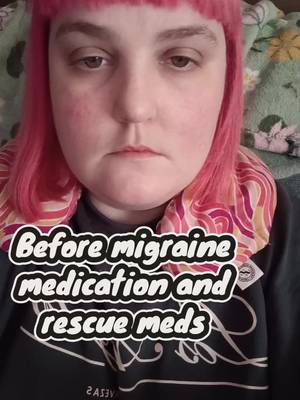 Migraines cause physical changes to my eyes, droopey eyelids, sometimes one eye will turn in or they will go in strange directions. In the first clip I just appear tired, I wasn't. The second clip was taken less than an hour later and my eyes are more open, both looking forwards, no more dropping and they look brighter. I hope one day science figures out what migraines are.