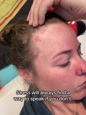 Guys, look at all my baby hairs! ☺️Stumbled on this clip today, reflecting is crazy because I’ve been complaining that I still lose so much hair - completely forgetting that there was a time it wouldn’t even grow in patches. #hairloss #eczema #stress