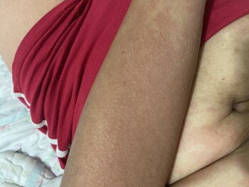 Consumer Review - Food Safety Family Dollar, Warburton Avenue, Yonkers, NY, USA yesterda i got hives all over my body i sent my se... photo #1