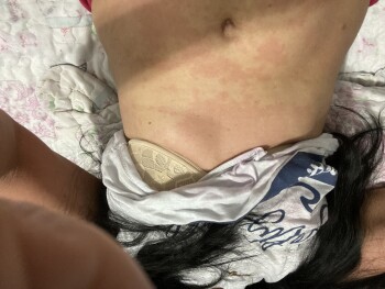 Consumer Review - Food Safety Family Dollar, Warburton Avenue, Yonkers, NY, USA yesterda i got hives all over my body i sent my se... photo #2
