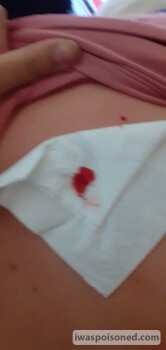 مراجعة المستهلك - سلامة الغذاء Nguni Grill, Morris Street, Bendor, Polokwane, South Africa Toxin build up in my Lymph Glands. High... صورة فوتوغرافية #9