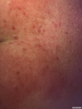Consumer Review - Food Safety ALDI, Old Carriage Court, Shakopee, MN, USA I got scombroid poisoning from fresh salmon from in Augu... photo #1