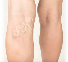 Finding the Best Varicose Veins Specialist in Indi