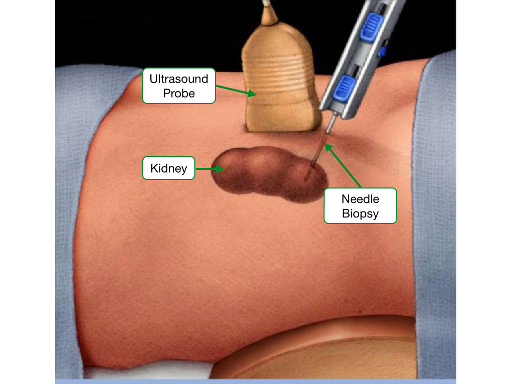 Cartoon of a needle biopsy of the kidney